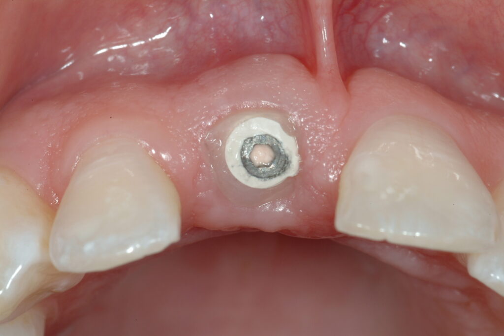 broken tooth dental implant in human dentura