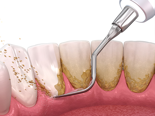 Periodontal Cleanings