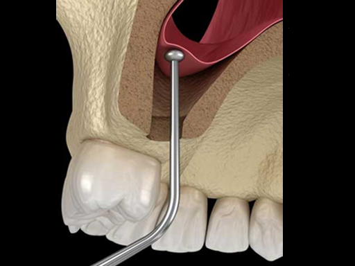 Sinus Augmentation