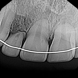 A close up of the teeth with wires attached to them
