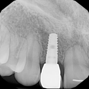 A tooth implant in the middle of its crown.