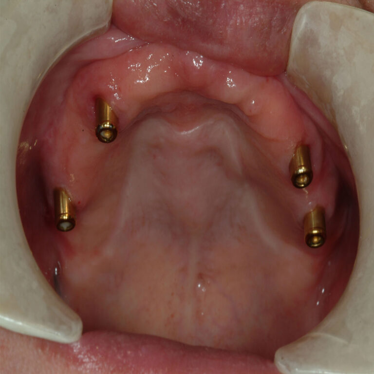 A close up of the inside of an implant