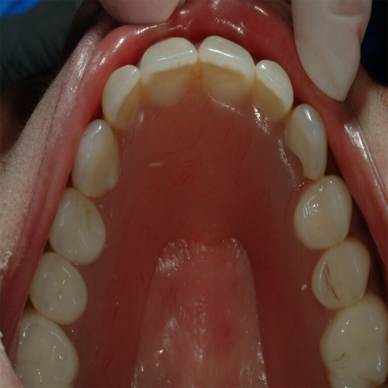 A person with their mouth open and teeth showing.