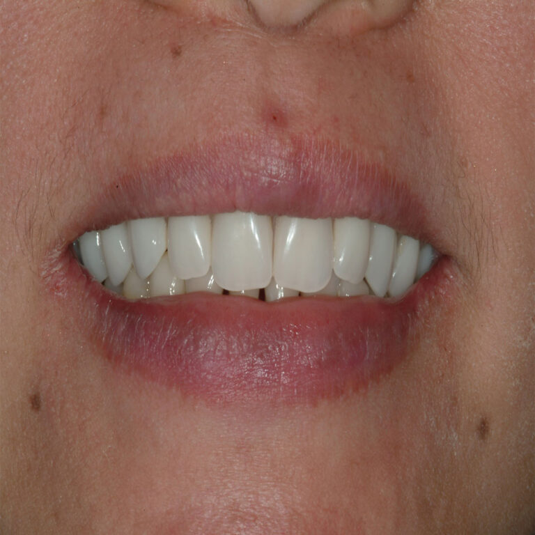 A woman with white teeth smiling for the camera.