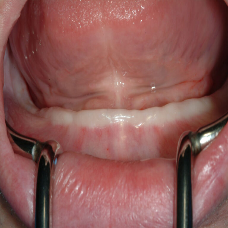 A close up of the mouth with two metal scissors