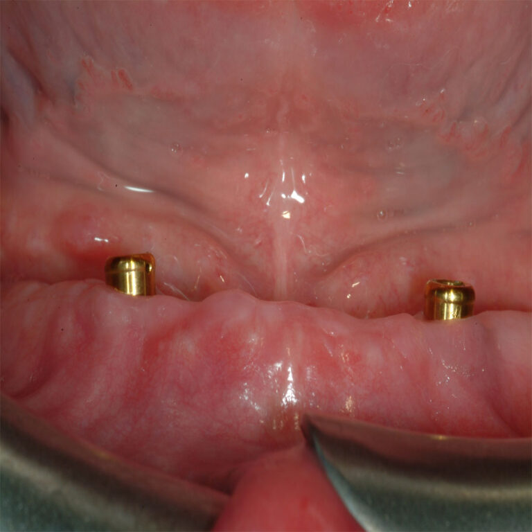 A close up of the mouth showing two small brass implants.