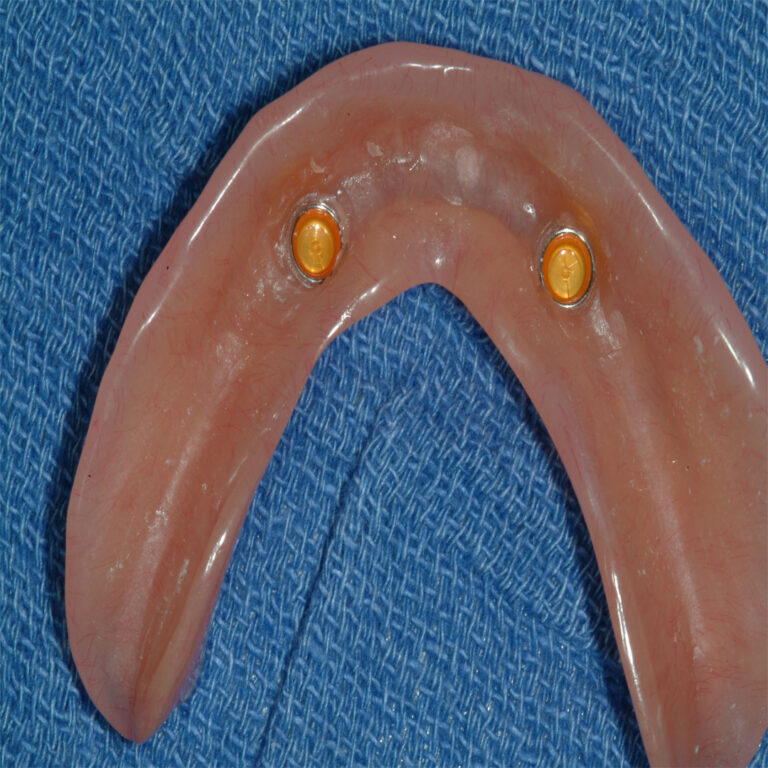 A close up of the bottom part of an artificial tooth