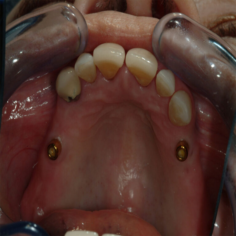 A close up of an open mouth with teeth and gums