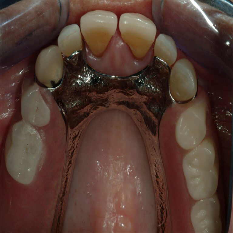 A close up of the teeth and gums