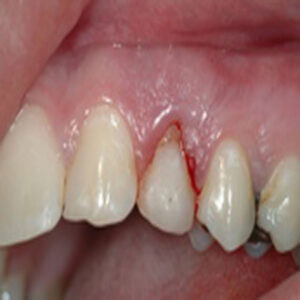 A close up of the teeth with tooth decay