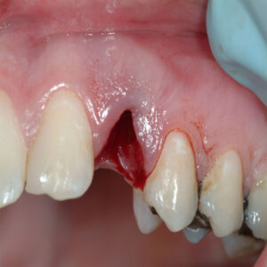 A close up of the teeth with an open mouth
