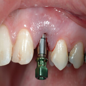 A close up of an individual 's teeth with a tooth implant.