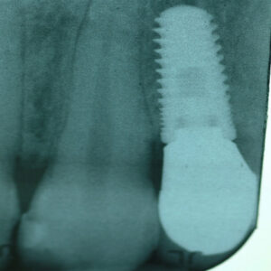 A tooth implant in the middle of an x-ray.