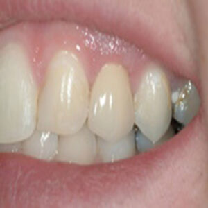 A close up of the teeth with an implant in it