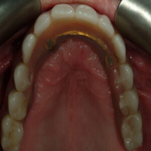 A close up of the teeth with an open mouth