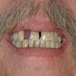 A man with missing teeth and no visible front tooth.