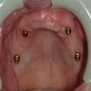 A close up of the inside of an implant retained denture.